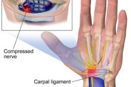 8 Natural Remedies for Carpal Tunnel Syndrome