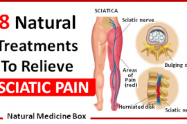 sciatica