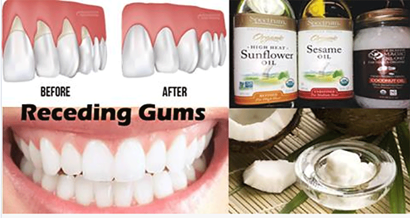 recedinggums