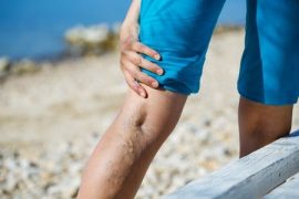 op 10 Home Remedies to Get Rid of Varicose Veins
