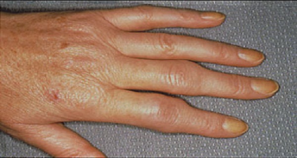 DIY An Ointment That Heals Rheumatism And Gout