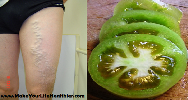 How to Cure Varicose Veins with the Help of Tomato