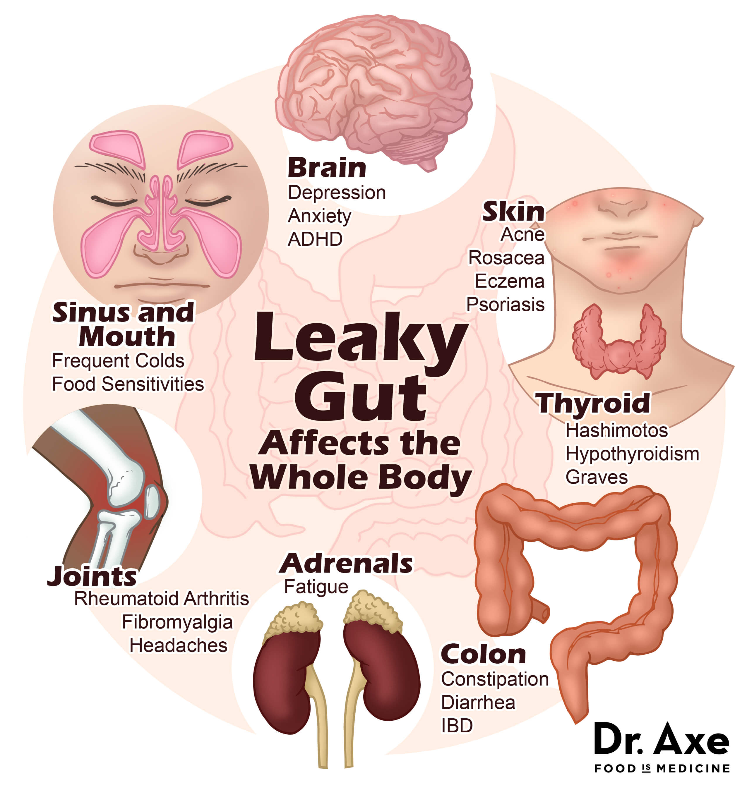 leaky gut syndrome symptoms