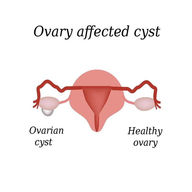 ovarian cysts